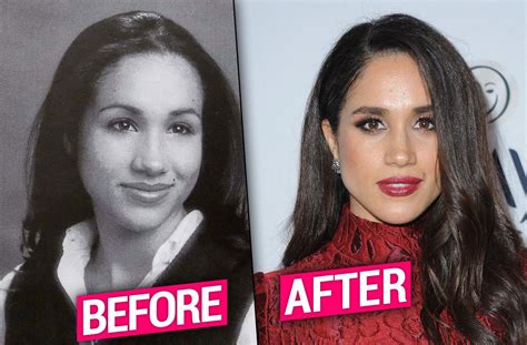 meghan markle nose job|Find Out Why Meghan Markles Nose Is A Plastic Surgery Trend!